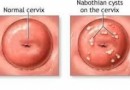 hình ảnh nang naboth cổ tử cung