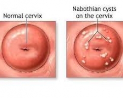 hình ảnh nang naboth cổ tử cung