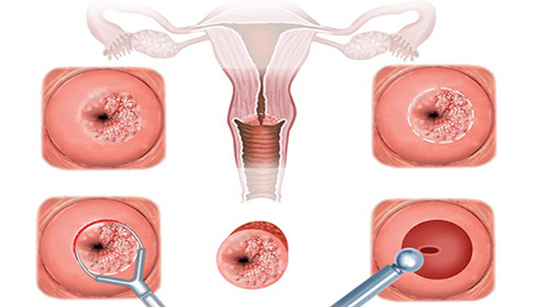 hinh anh nang naboth cổ tử cung